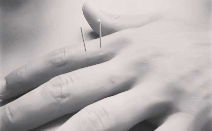 Exploring Acupuncture An Ancient Practice for Modern Wellness